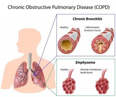 copd.jpg