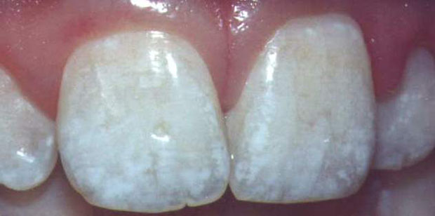 fluorosis.jpg